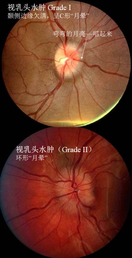 视乳头水肿是颅内压增高的常见表现,但不是只有颅内压增高会引起视