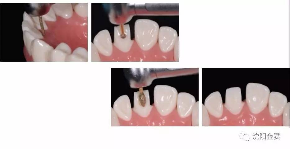 【金赛义齿】前牙全瓷冠牙体预备步骤