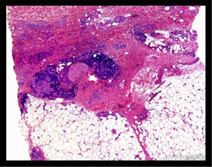 【皮肤超声】类脂质渐进性坏死 necrobiosis lipoidica【文献学习】