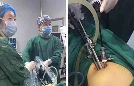 我院成功开展一例经脐单孔腹腔镜下子宫肌瘤切除术