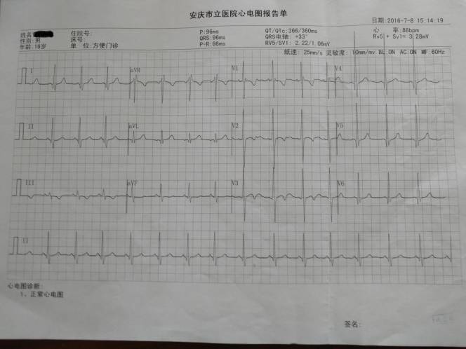 近日holter报告提示为窦性心律,平均心率75次/分(最慢心率64次/分,最