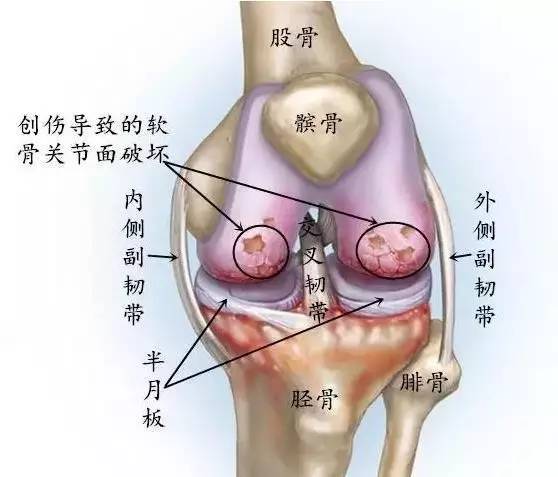 哪些人适合膝关节置换手术?