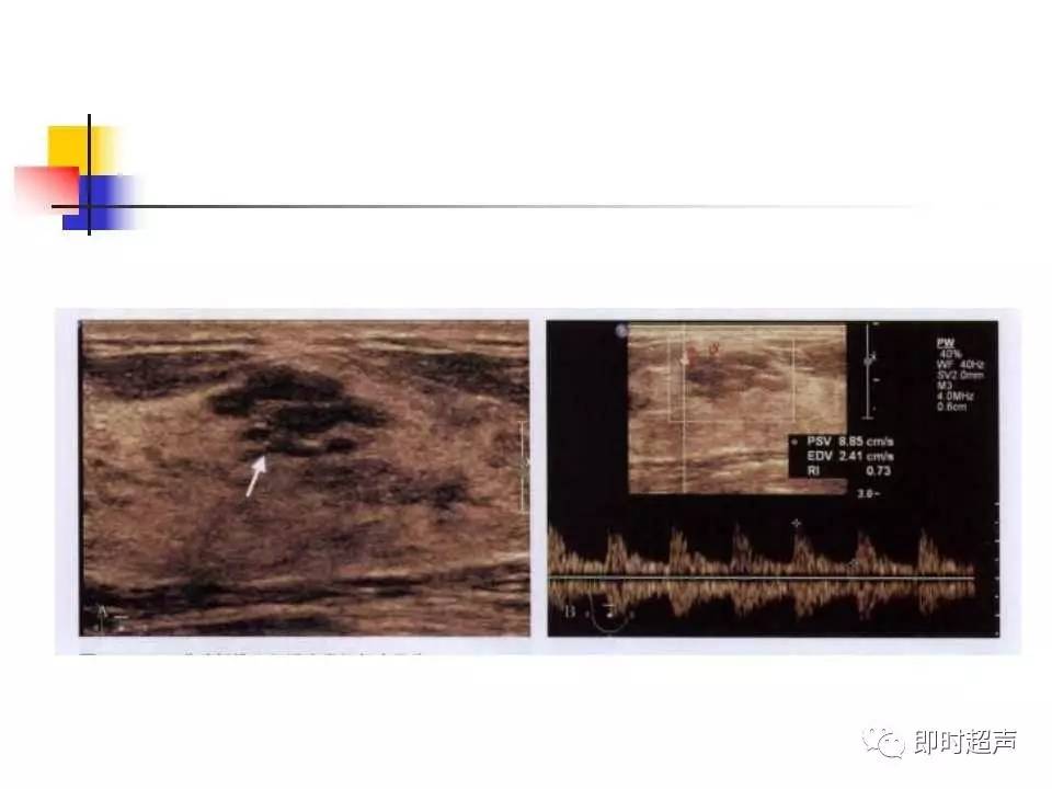 乳腺疾病的超声造影