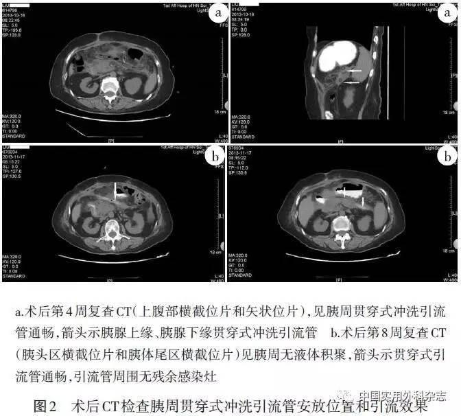 论著胰周贯穿式冲洗引流用于感染性胰腺坏死疗效分析