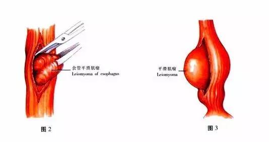 美女吃不下饭 一查竟是12厘米肿瘤…这习惯你有吗?马上改!