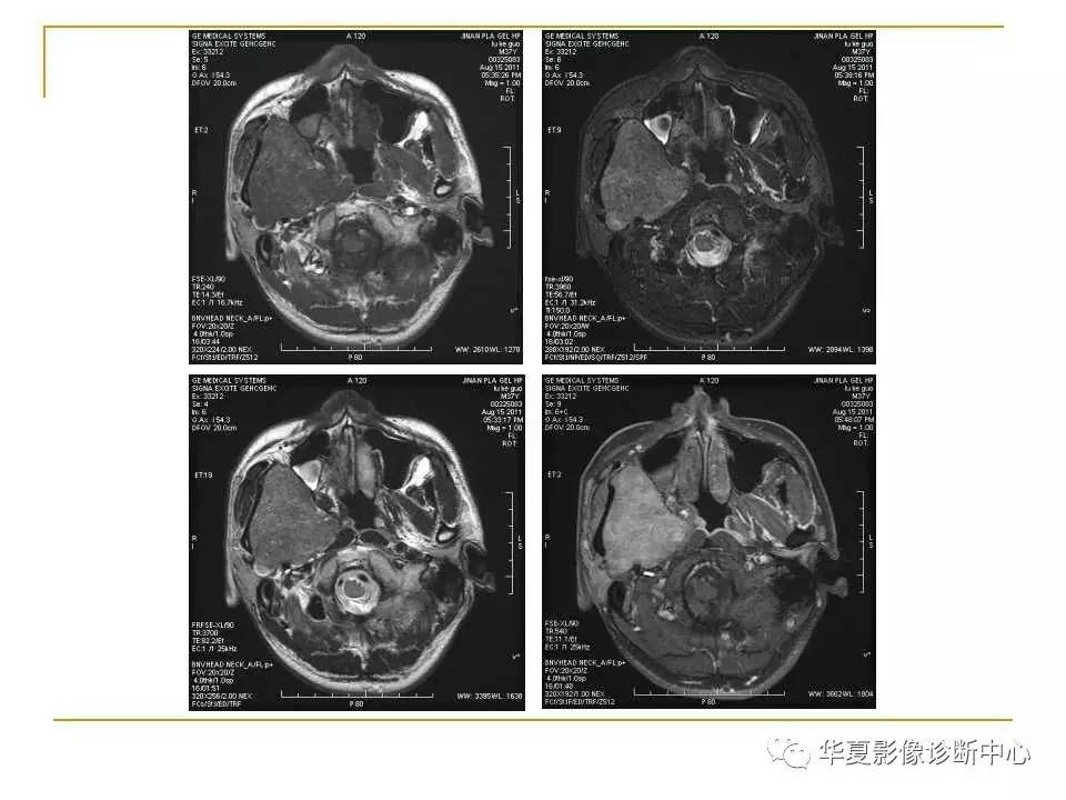 干货腮腺混合瘤mri诊断