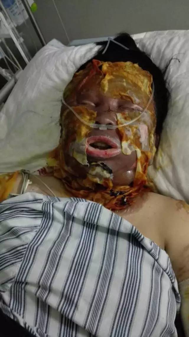 募捐7月4日葵潭发生煤气爆炸一孕妇被严重烧伤