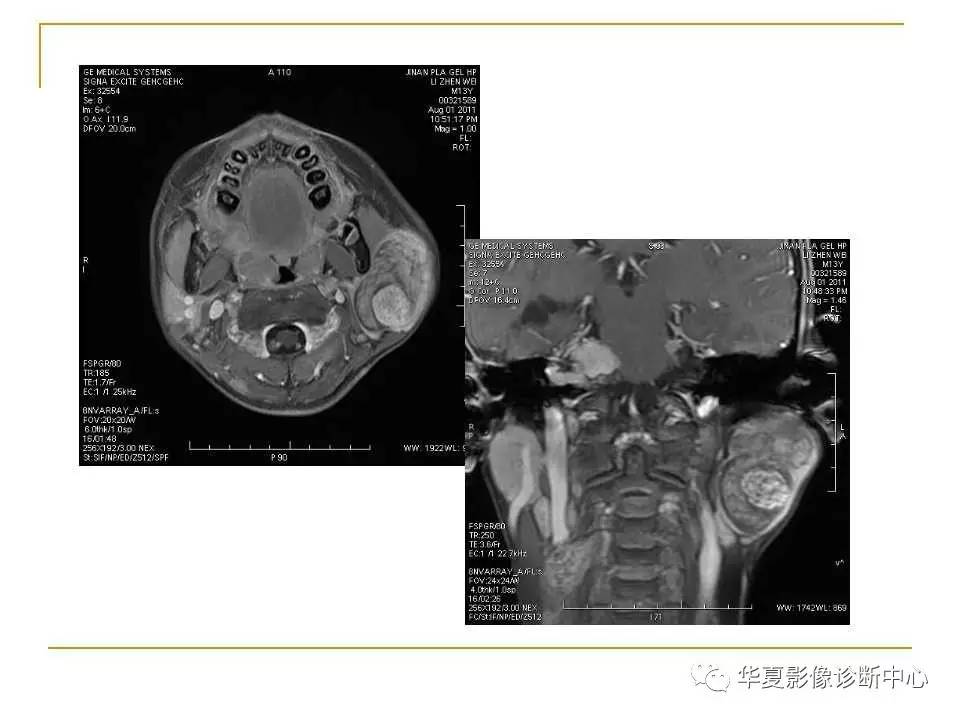干货腮腺混合瘤mri诊断