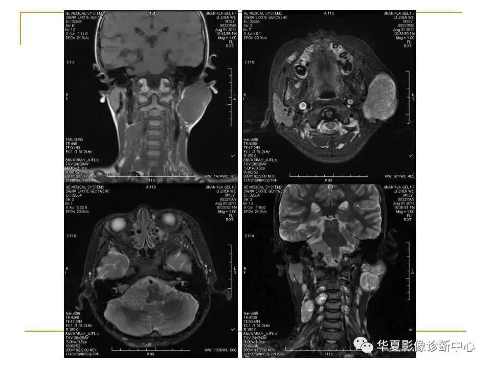 (干货)腮腺混合瘤mri诊断