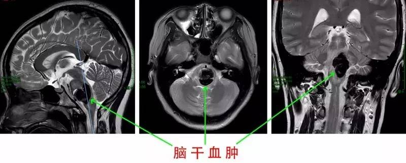 仁济要闻|致命血肿压迫脑干 仁济医生妙手转危为安