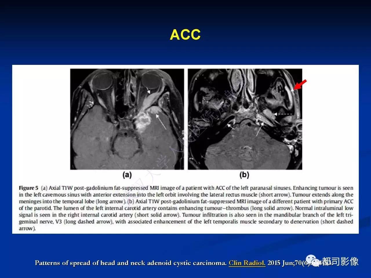 头颈部腺样囊性癌伴周围神经浸润影像诊断