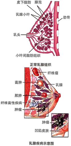 乳腺小叶增生要不要紧,平时要注意什么