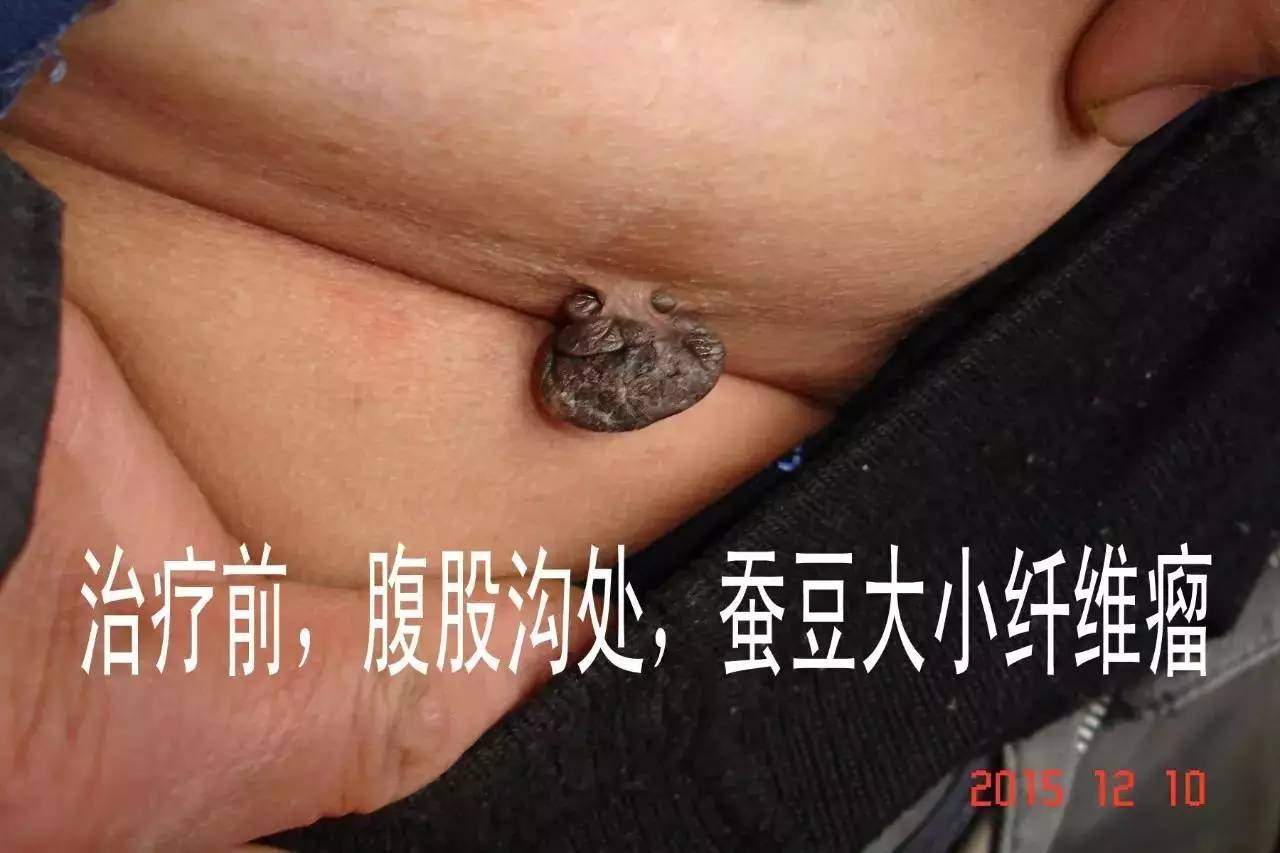 高龄老人皮肤大肉瘤(软纤维瘤 soft fibroma),如何