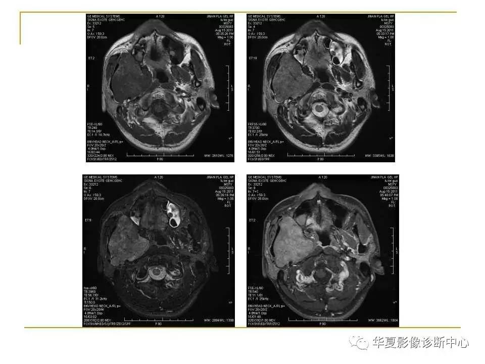 干货腮腺混合瘤mri诊断