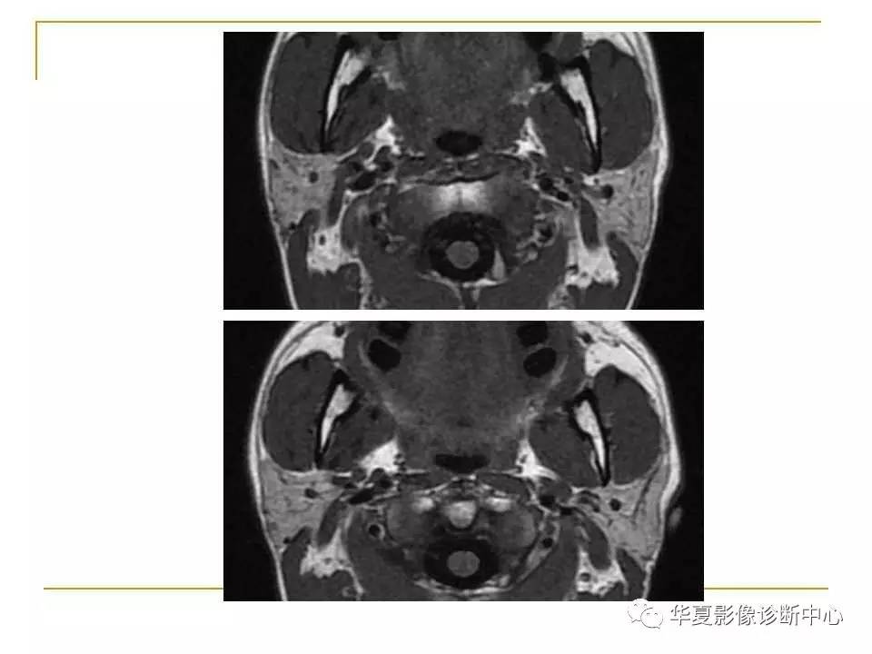 (干货)腮腺混合瘤mri诊断