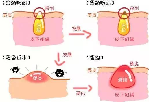 闭口粉刺是什么鬼?居然那么多人分不清楚它和痘痘的