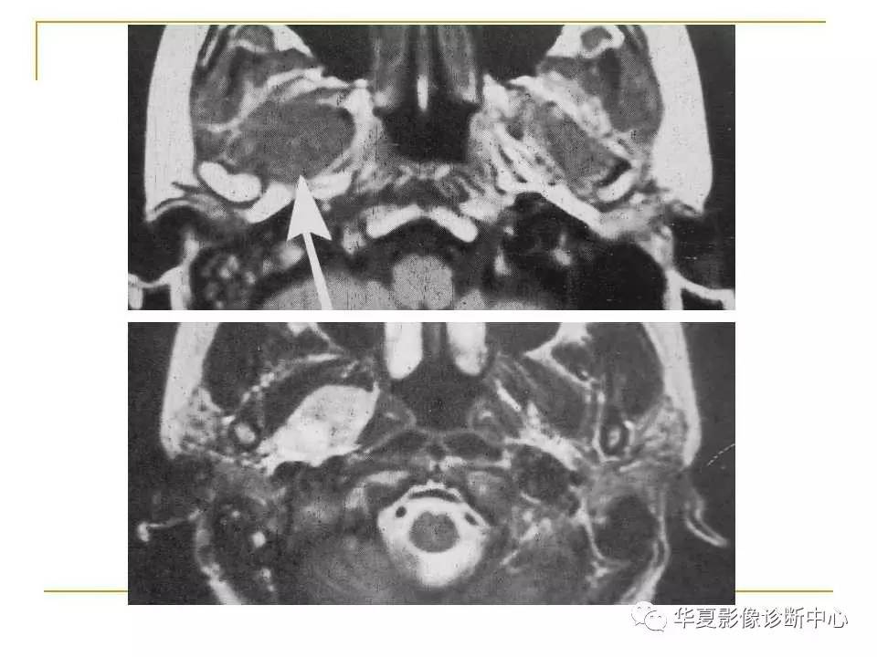 (干货)腮腺混合瘤mri诊断