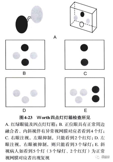 【专业】双眼单视功能检查(worth四点灯试验)—《斜视