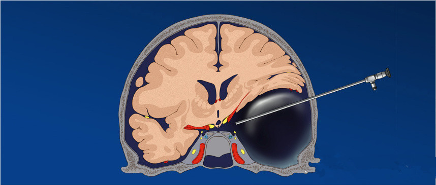 随着临床医学的发展,蛛网膜囊肿手术治疗的方式主要有囊肿-腹腔分流术