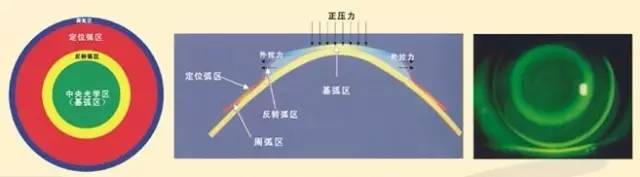 角膜塑形镜是一种特制的隐形眼镜,夜间睡眠时配戴,可有效控制青少年