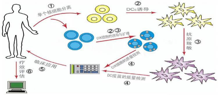 dc-cik细胞免疫过继疗法