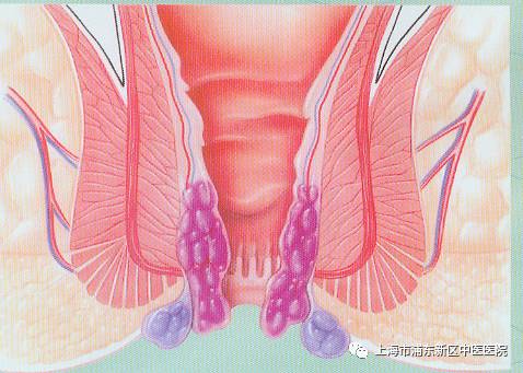 痔疮垫什么原理_轻微的痔疮长什么样子(3)