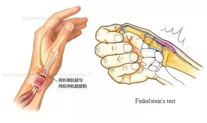 临床表现 桡骨茎突狭窄性腱鞘炎是出现在腕部拇指一侧的骨突(桡骨