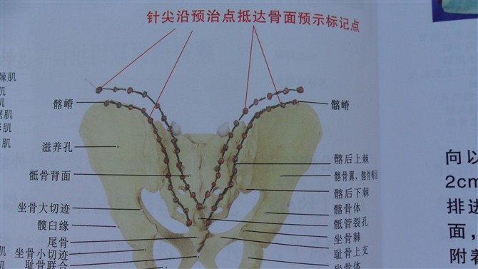 骶髂部银质针情况