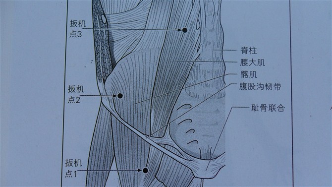 髂腰肌治疗,读书文摘!