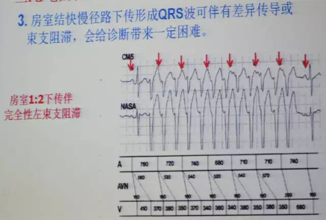 郭继鸿|压箱底!室上速心电图的辨别