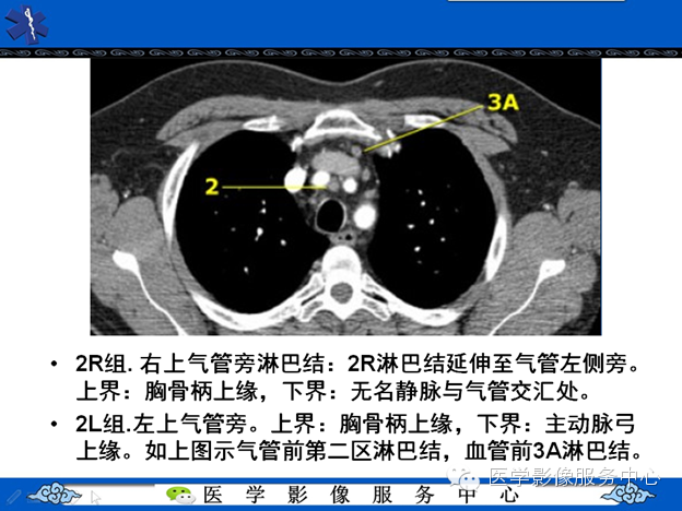 在ct诊断中如何发现纵隔淋巴结增大