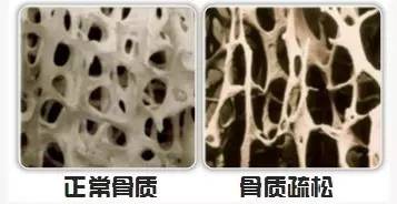 【一图一话】吃钙片为什么治不好骨质疏松?