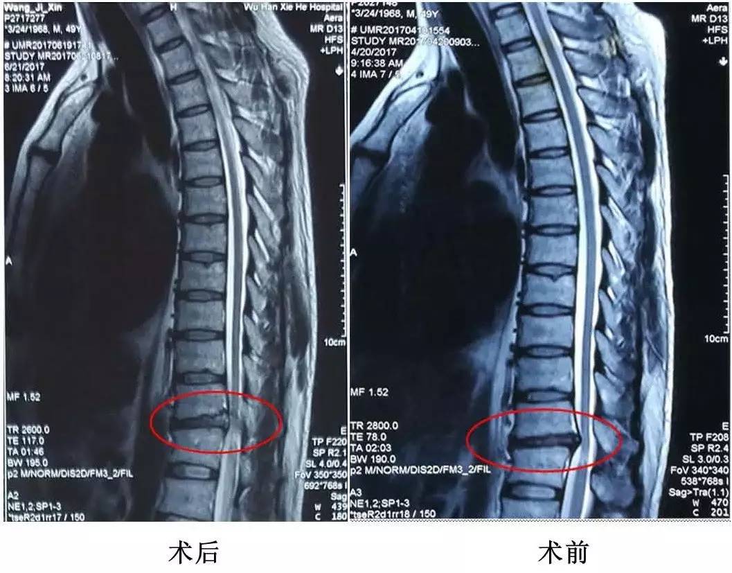 【超能刀客】"止麻先锋"故事会│016号 椎间孔镜手术治疗胸椎管狭窄症