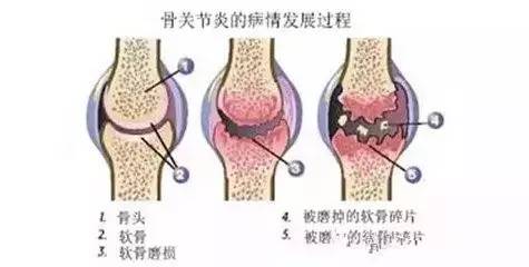 膝关节常见疾病,你知道几个