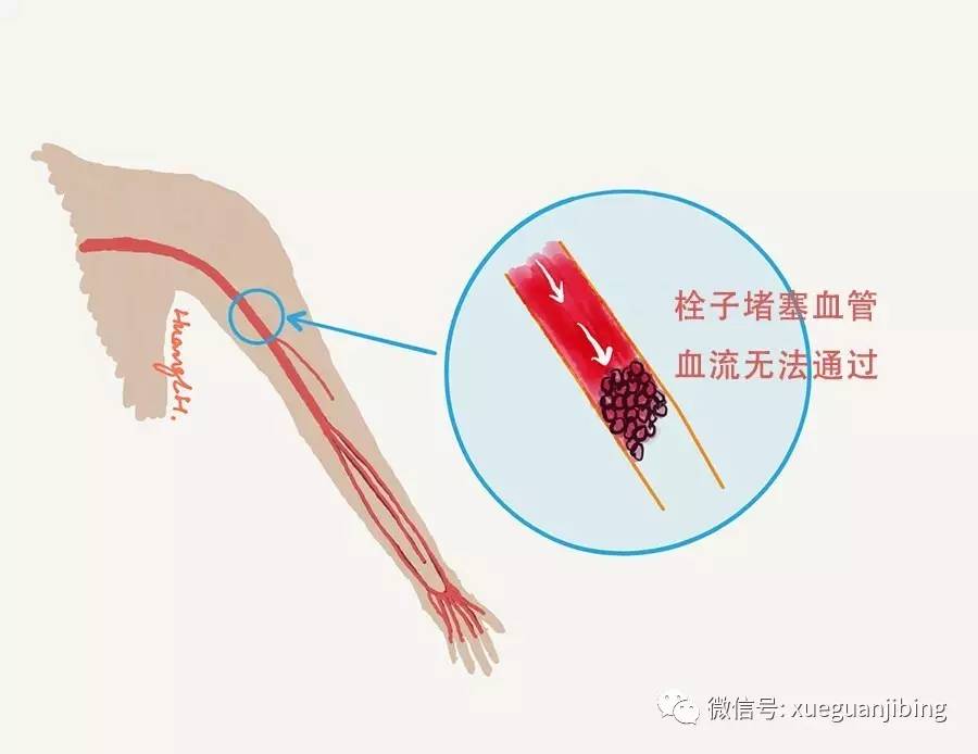 结合血管超声等检查,诊断急性左上肢动脉栓塞.见下图.