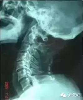 颈椎X线平片读片诊断口诀