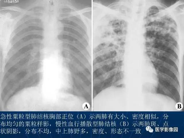 肺部感染性疾病的影像观察与分析影像天地