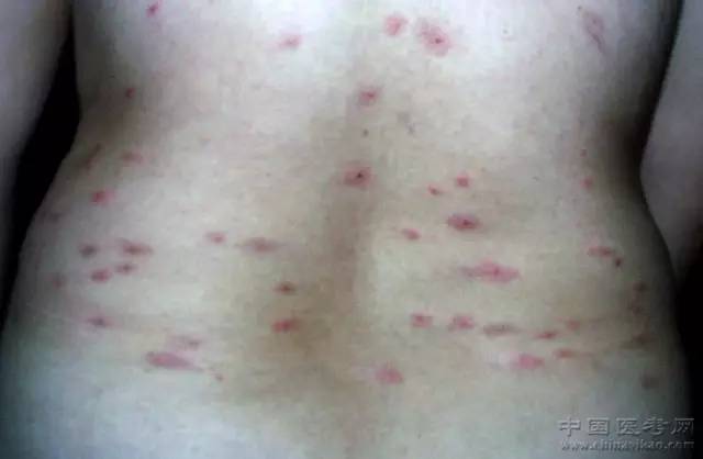 昆明看荨麻疹,后背有点小红点,热了还感觉痒。