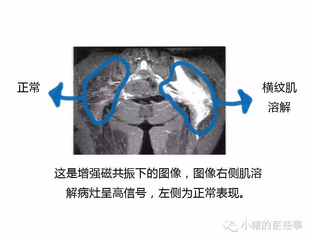 小龙虾有风险,吃货要小心--横纹肌溶解综合征