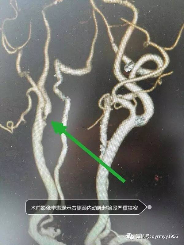 最终,经医师们在显微镜下的仔细剥离,这块堵塞颈动脉的"垃圾"终于被