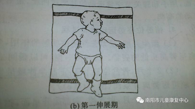 母婴 正文 正常新生儿出生后呈现肌张力增高状态 屈肌,伸肌肌张力不