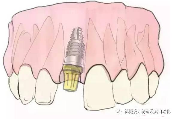 种牙螺丝掉了怎么办