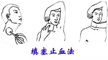 3.填塞止血法