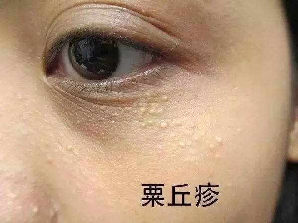 内衣脂肪粒_眼部脂肪粒图片(2)