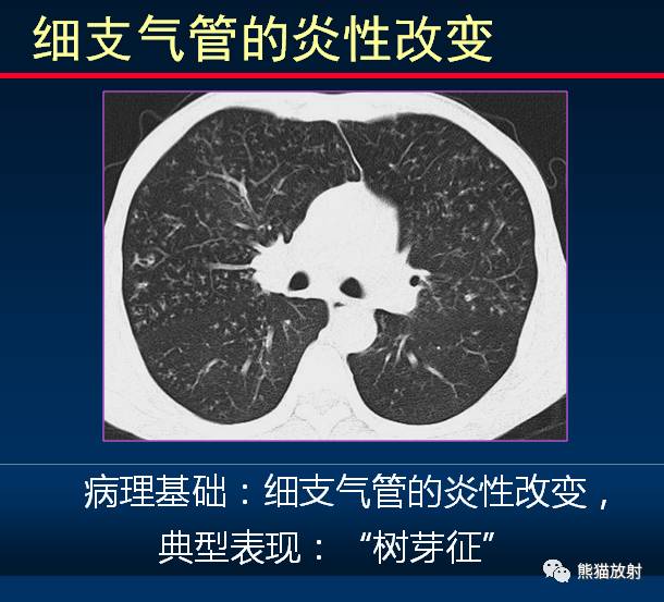 也可以是支气管肺炎的前驱改变