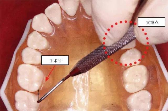 【牙周治疗笔记】学习牙周基础治疗之探针