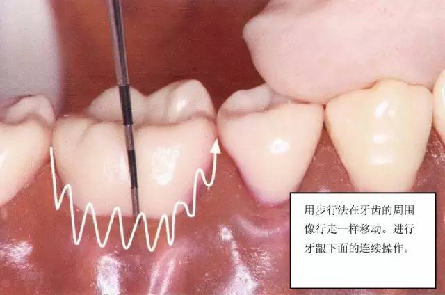 【牙周治疗笔记】学习牙周基础治疗之探针