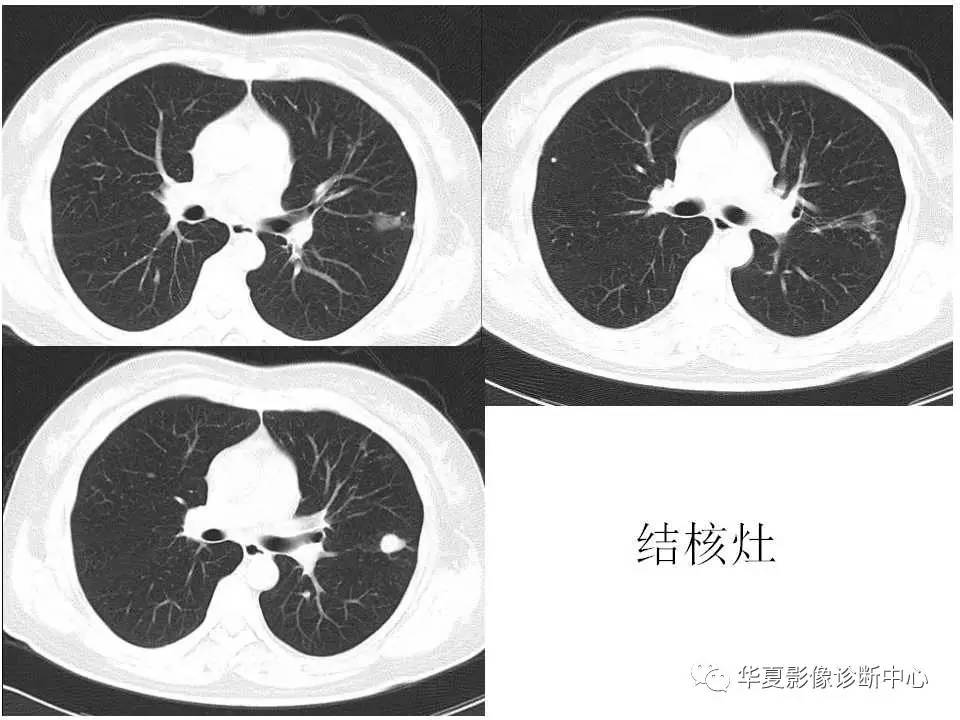 【影像基础】不典型肺结核的影像学鉴别诊断