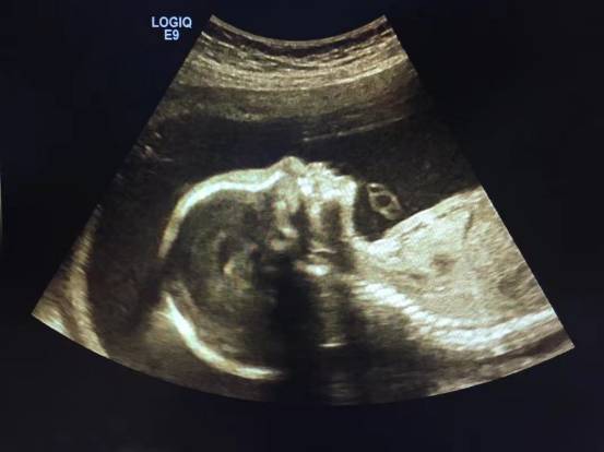 图2:13周胎儿nt检查 二维图像 2,中晚孕期超声检查: (1)一般产前超声