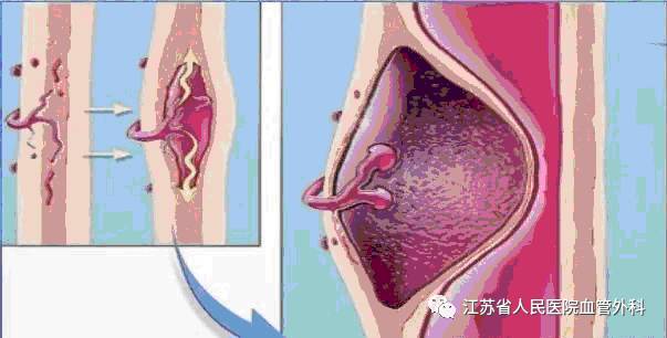 【学术动态】动脉疾病知识,你知道多少?